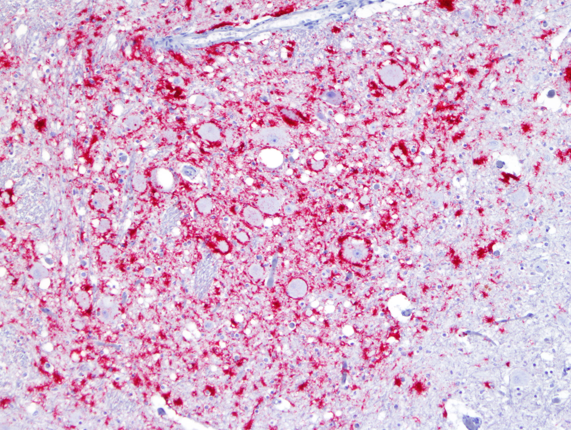 microscopic image of Chronic Wasting Disease